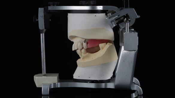 Newsletter 56 showing the making and fitting of a bilateral free end saddle upper removable partial denture (RPD) for patient with pemphigus
