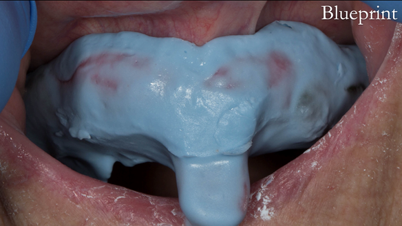 Figure 61 Definitive impression made in alginate (Blueprint)
