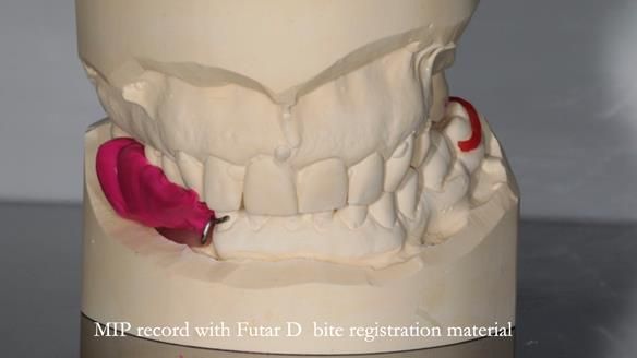 Finlay's Newsletter 61 provision of a lower unilateral free end saddle metal based partial denture for Joyce