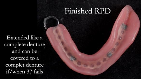 Finlay's Newsletter 59 Ultra hard partial dentures made for Gill