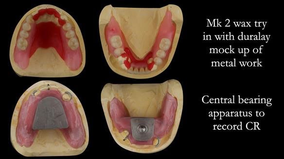 Finlay's Case Study Newsletter 40 - Immediate Mk 1 RPD to Definitive Mk 2 RPD - full protocol