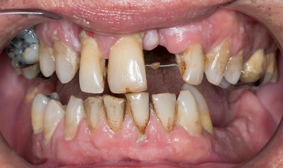 Figure 4 Pre-treatment with generalised periodontitis; stage IV grade C, unstable, risk factors: smoker. Prior to phase one treatment of immediate complete upper denture and immediate mandibular acrylic based partial denture.