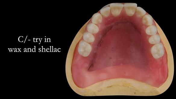 Managing poor implant positioning with complete dentures and Locator attachments - full protocol Newsletter 41