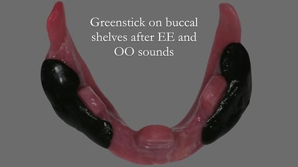 Finlay's Newsletter 62 provision of extractions and metal based complete dentures for Rafique