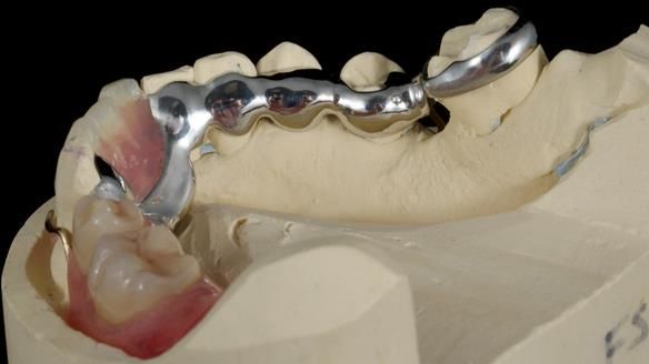 Newsletter 86 Peter the Architect — precision removable partial dentures case study
