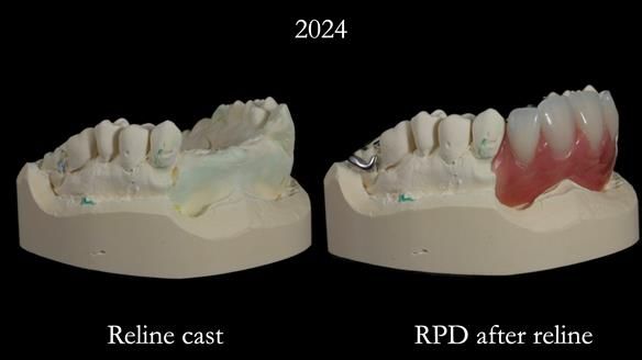Newsletter 66 Long term case study. Life changing metal based RPD made for Anna