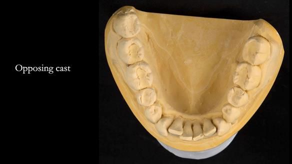 Finlay's Newsletter 63 Case study provision of metal based Scandinavian RPD - functional 10 years on