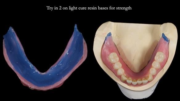 Newsletter 80 - Gordon’s dentures: the one case in 1,000 where my technique failed