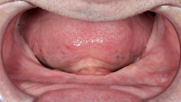 Newsletter 80 - Gordon’s dentures: the one case in 1,000 where my technique failed