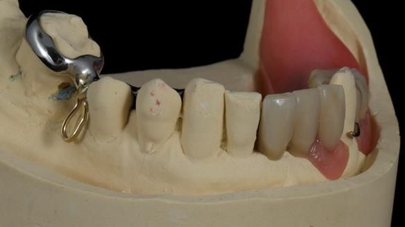 Newsletter 86 Peter the Architect — precision removable partial dentures case study