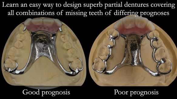 Finlay's Newsletter 59 Ultra hard partial dentures made for Gill