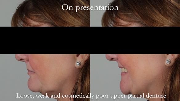 Finlay's Newsletter 58 Gasket upper partial denture for Zoe