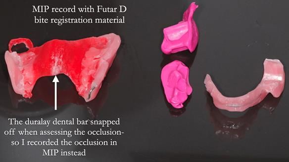 Finlay's Newsletter 60 Sylvia's upper Kennedy Class 2 Mod 1 metal based upper RPD
