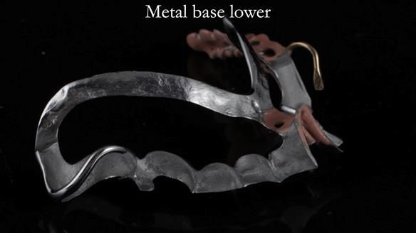 Newsletter 54 case presentation upper complete denture and lower Scandinavian designed hygienic partial denture for David