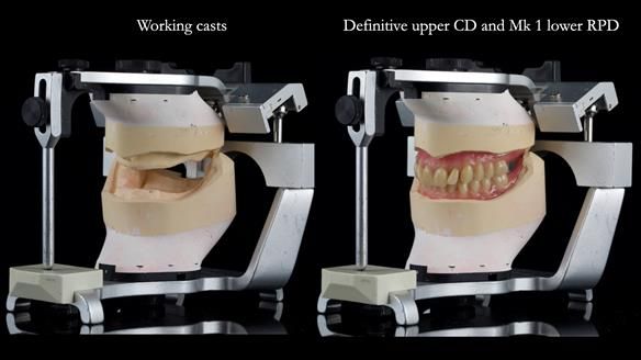 Newsletter 82 Mary - A complete upper and a one-tooth gasket denture