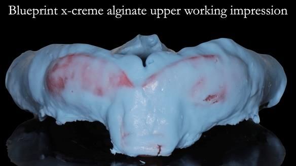 Newsletter 50 Special edition Complete Dentures FULL PROTOCOL