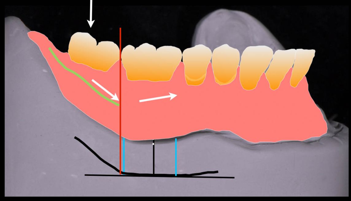 Why do we generally leave the second molars off complete dentures? Diagram courtesy of John Wibberley. 