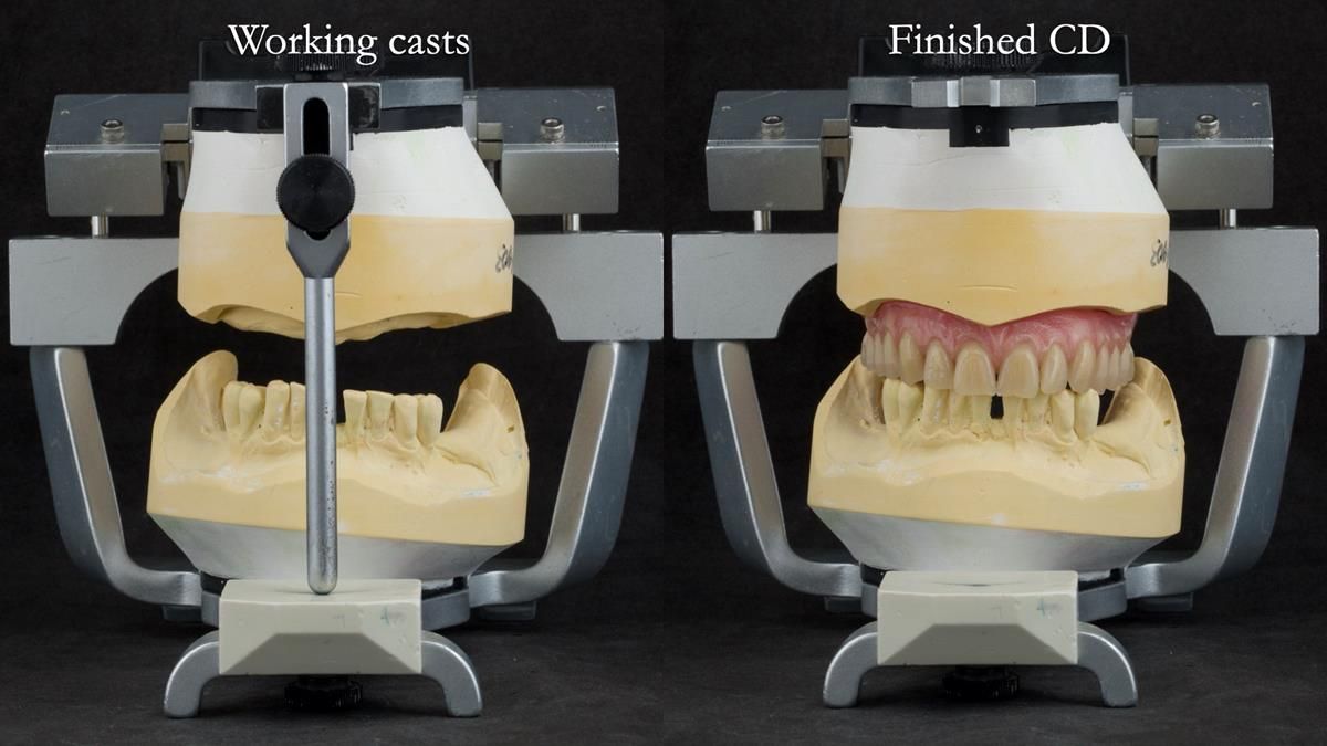 Newsletter 87 – Father Peter: A Partial Denture that needed Minor Miracle