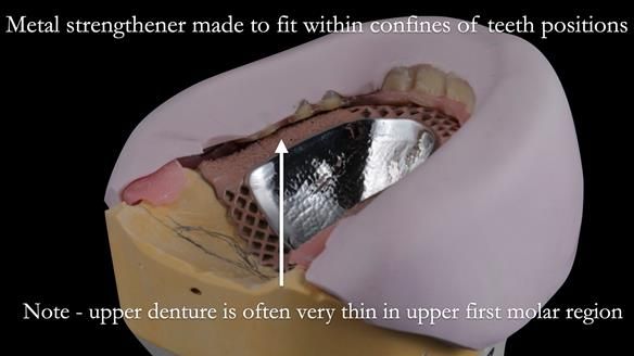 Newsletter 53 showing the making and fitting of ultra life-like dentures for Valena