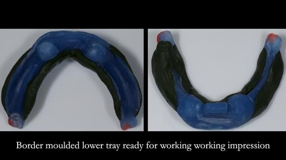 Newsletter 78: What do Clark Gable and a Locator® overdenture have in common?