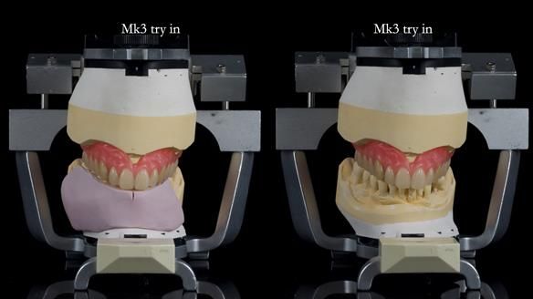 Newsletter 77: Jeremy’s case – immediate complete upper denture