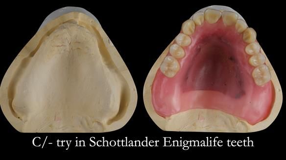 Newsletter 54 case presentation upper complete denture and lower Scandinavian designed hygienic partial denture for David