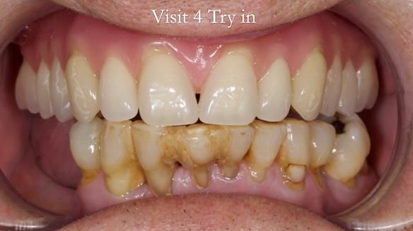Newsletter 54 case presentation upper complete denture and lower Scandinavian designed hygienic partial denture for David