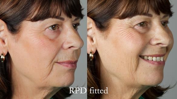 Newsletter 56 showing the making and fitting of a bilateral free end saddle upper removable partial denture (RPD) for patient with pemphigus