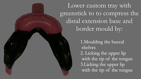 Newsletter 52 Managing Jo’s failing dentition with extractions and Mk 1/Mk 2 complete upper dentures and lower partial dentures FULL PROTOCOL