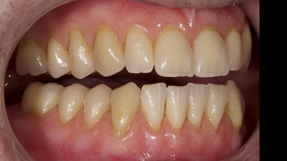 Newsletter 80 - Gordon’s dentures: the one case in 1,000 where my technique failed