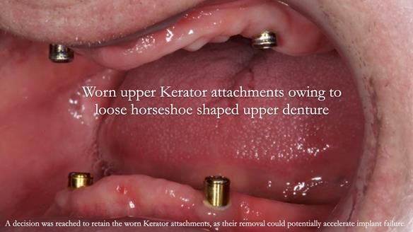 Newsletter 57 showcases the making and fitting process of implant-supported complete dentures for Alisdair