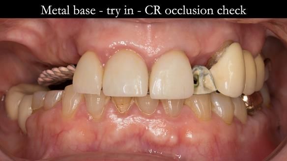 Newsletter 51 Managing Anne’s failing dentition with distal extension base RPD/Splint FULL PROTOCOL