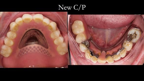 Newsletter 54 case presentation upper complete denture and lower Scandinavian designed hygienic partial denture for David