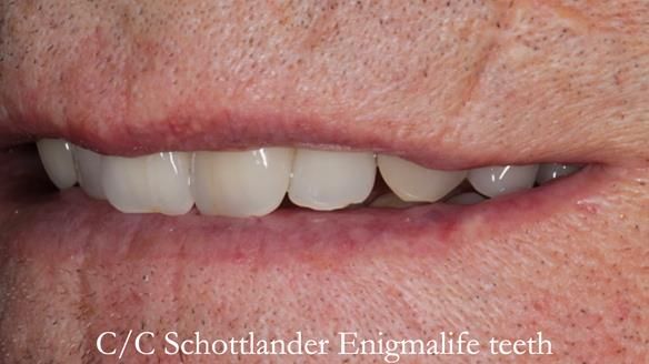 Newsletter 50 Special edition Complete Dentures FULL PROTOCOL