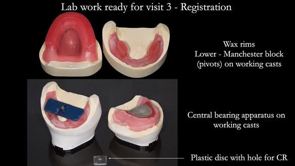 Newsletter 50 Special edition Complete Dentures FULL PROTOCOL