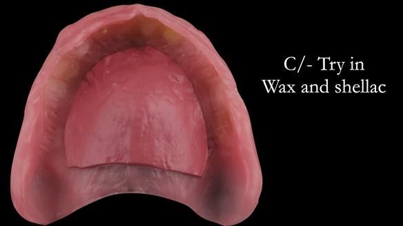Complete denture Class II div 2 deep overbite Newsletter 39