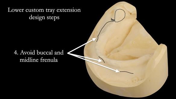 Newsletter 50 Special edition Complete Dentures FULL PROTOCOL