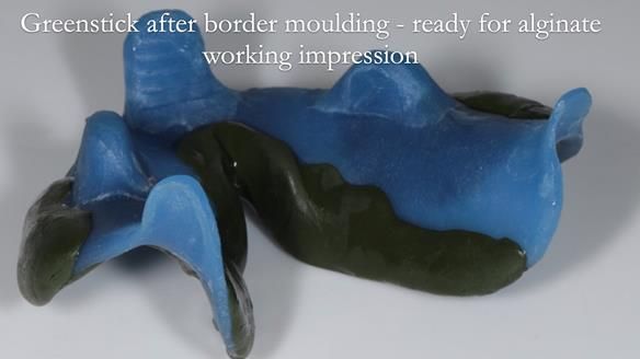 Newsletter 53 showing the making and fitting of ultra life-like dentures for Valena