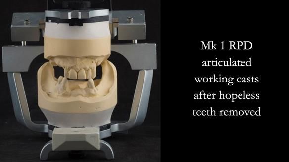 Finlay's Case Study Newsletter 40 - Immediate Mk 1 RPD to Definitive Mk 2 RPD - full protocol
