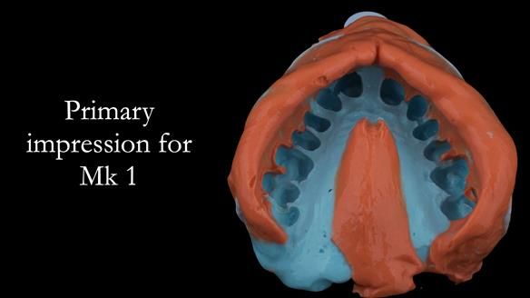 Finlay's Newsletter 63 Case study provision of metal based Scandinavian RPD - functional 10 years on