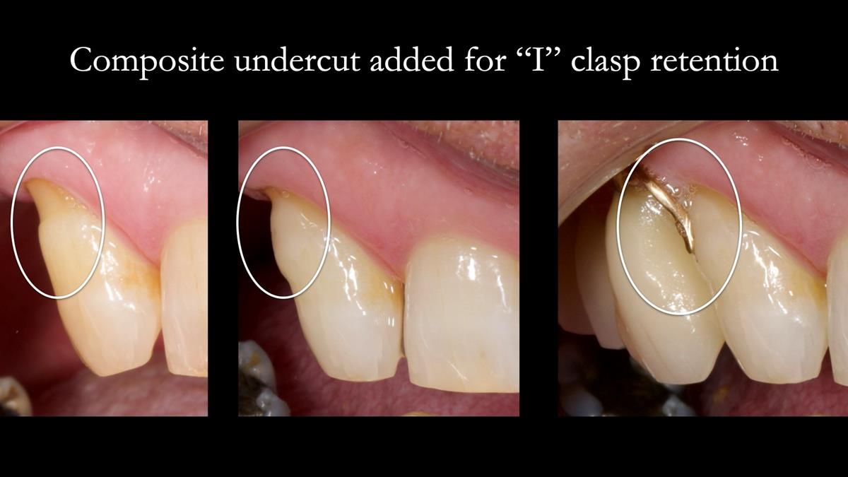 Newsletter 86 Peter the Architect — precision removable partial dentures case study