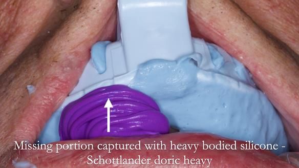 Newsletter 54 case presentation upper complete denture and lower Scandinavian designed hygienic partial denture for David