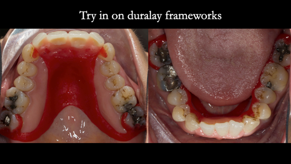 Figure 66 Teeth try in on pattern resin bases in the mouth. These help to confirm the accuracy of the working casts and the amount of metal work which will be visible in the final dentures