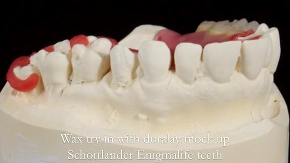 Finlay's Newsletter 64 case study - provision of a Kennedy class 2 metal based Scandinavian RPD for Ian