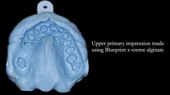 Finlay's Newsletter 61 provision of a lower unilateral free end saddle metal based partial denture for Joyce