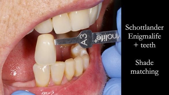 Finlay's Newsletter 61 provision of a lower unilateral free end saddle metal based partial denture for Joyce