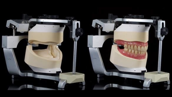 Newsletter 80 - Gordon’s dentures: the one case in 1,000 where my technique failed