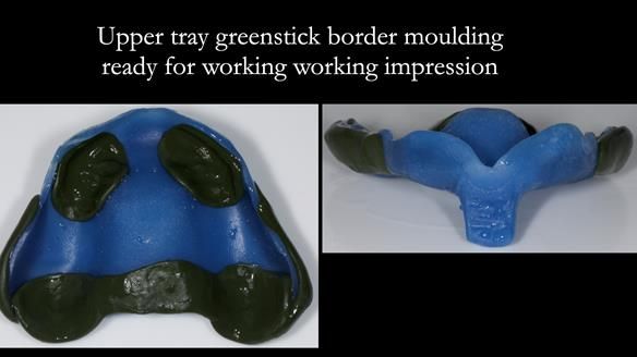 Newsletter 78: What do Clark Gable and a Locator® overdenture have in common?