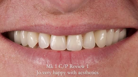 Newsletter 52 Managing Jo’s failing dentition with extractions and Mk 1/Mk 2 complete upper dentures and lower partial dentures FULL PROTOCOL