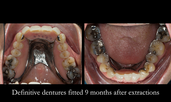 Figure 77 Definitive dentures fitted 9 months after extractions